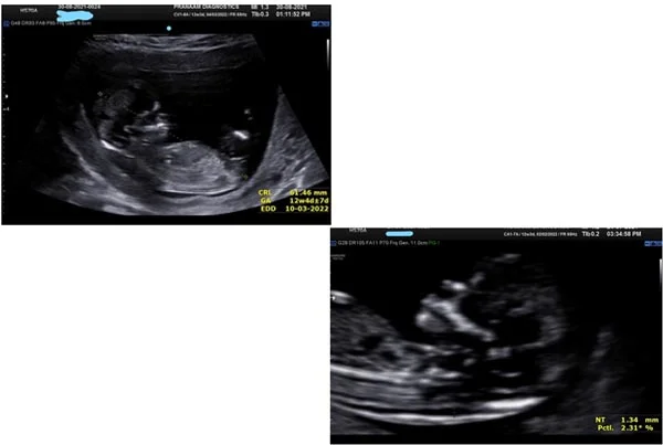 Ultrasound Images