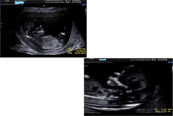 Ultrasound Images