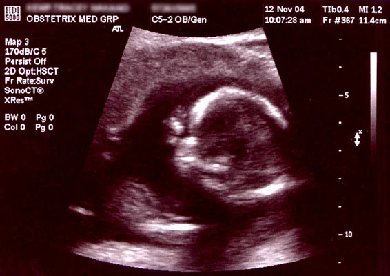 Ultrasound Images