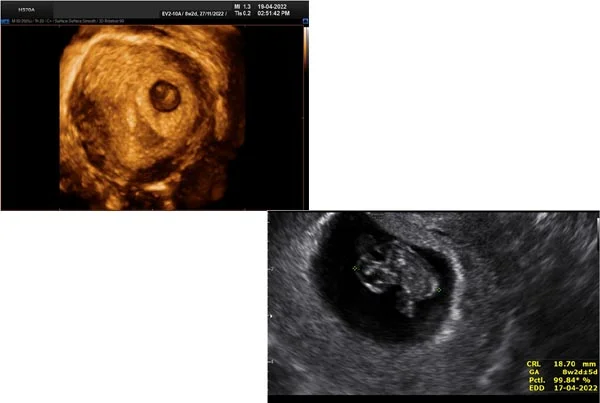 Ultrasound Images