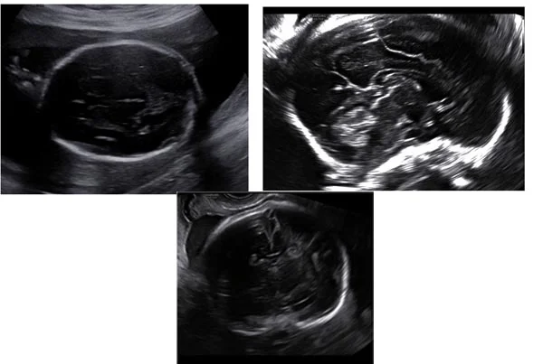Ultrasound Images'