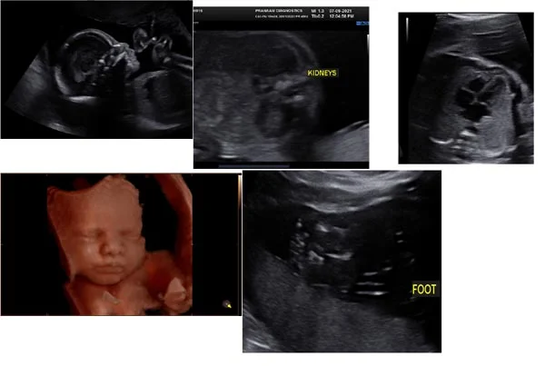 Ultrasound Images'