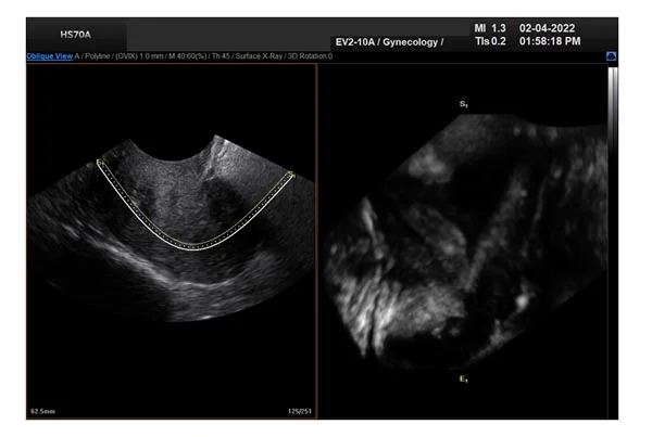 Ultrasound Images