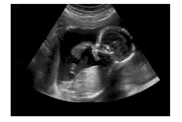 Ultrasound Images