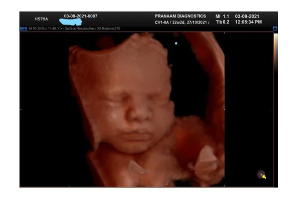 Ultrasound Images